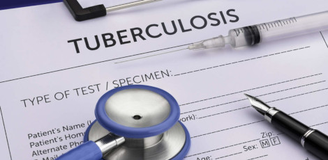Important Foods to eat for tuberculosis or TB – Lack of vitamin that would make a person more prone to TB!!