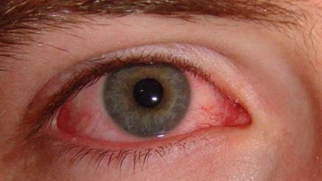 Madras Eye Prevention in Summer: Symptoms, Causes, and Safety Recommendations